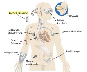 zu sehen sind verschiedene, mögliche metallische Implantate im Körper - von Kopf bis Fuß. Von Retina-Stimulator, Hörgerät, Cochlea-Implantat, Herzschrittmacher, bis Handprothese, Blasenschrittmacher und Insulinpumpe