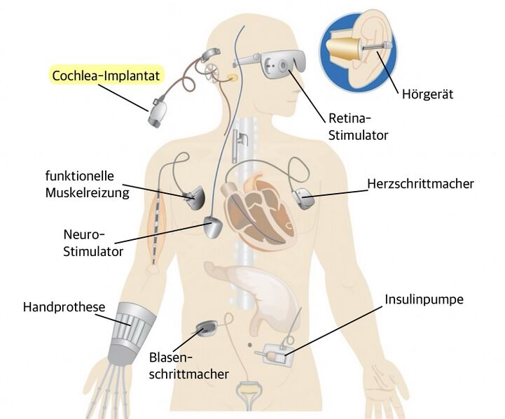 Datei:Verschiedene metallische Implantate im Körper.jpg